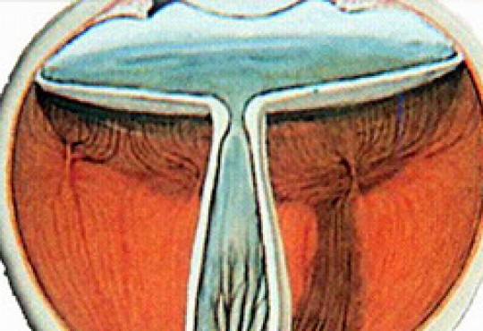 Retinopatía del prematuro img